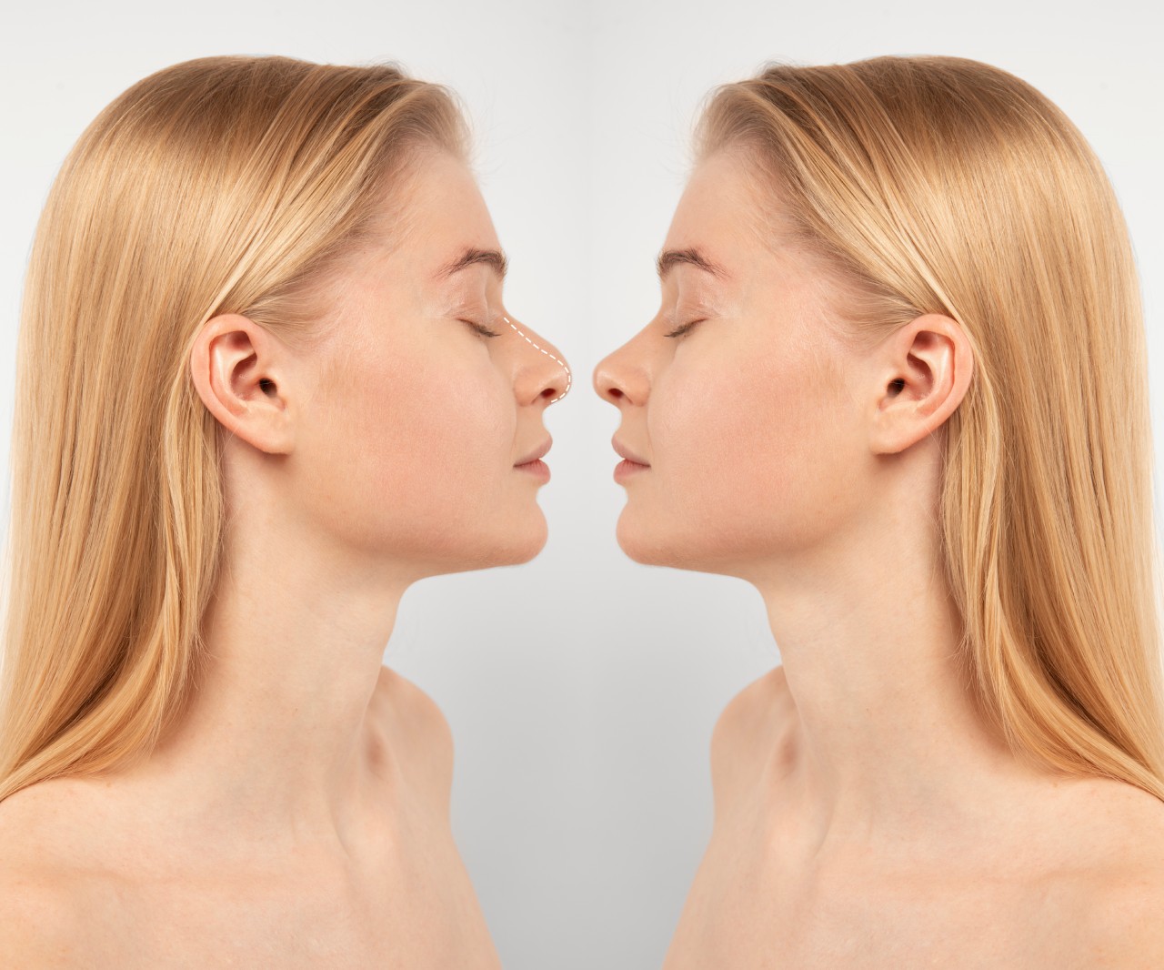 Rhinoplasty